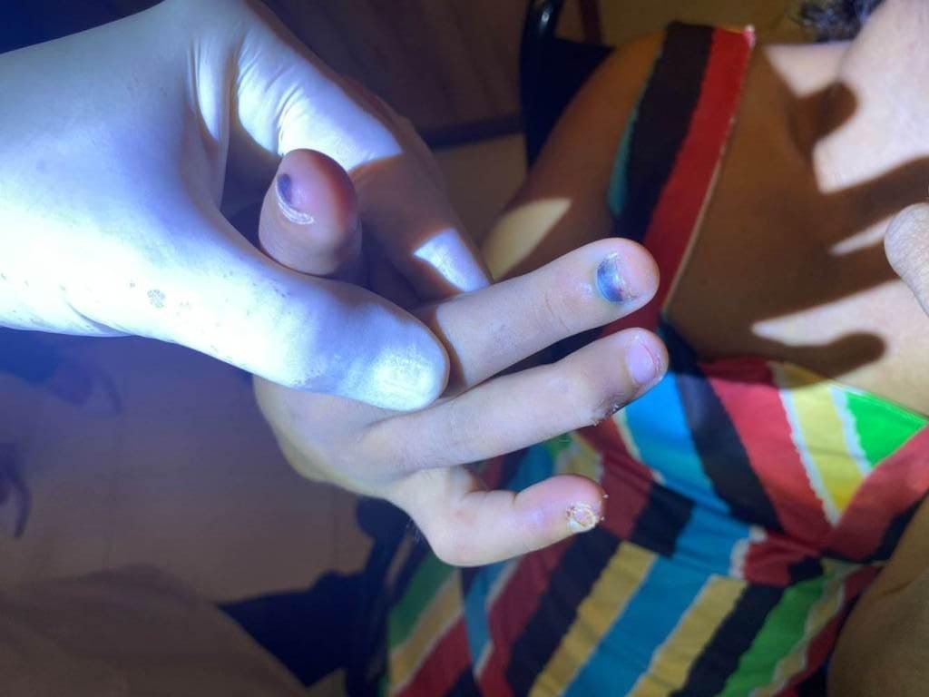 Mulher é presa suspeita de torturar a própria irmã cadeirante; vítima teve unhas arrancadas